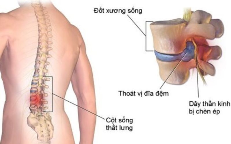 thoat vi dia dem co chua duoc khong 1